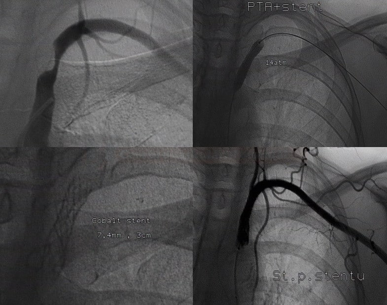 Subclavian Artery Stenting