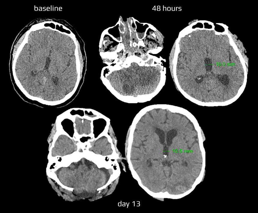 Cerebellar ischemia with hydrocephalus managed by with decompressive craniectomy