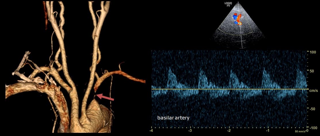 Subclavian artery stenosis with biphasic flow in the basilar artery