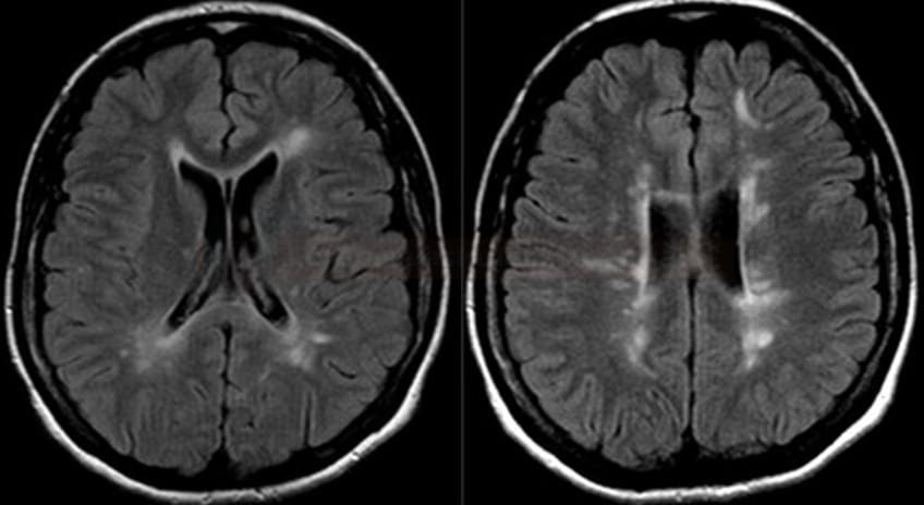 Hyperintense lesions on MRI in patient with antiphospholipid syndrome