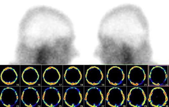 Brain death - static scintigraphy and SPECT