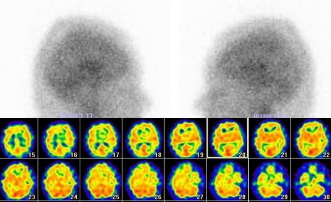 Decreased perfusion on static scintigraphy and SPECT
