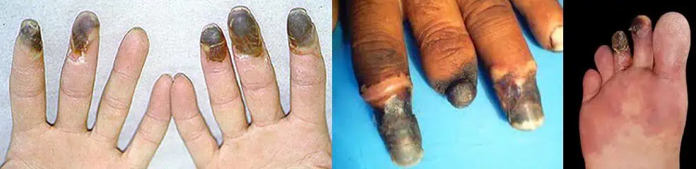 Gangrene in Buerger's disease