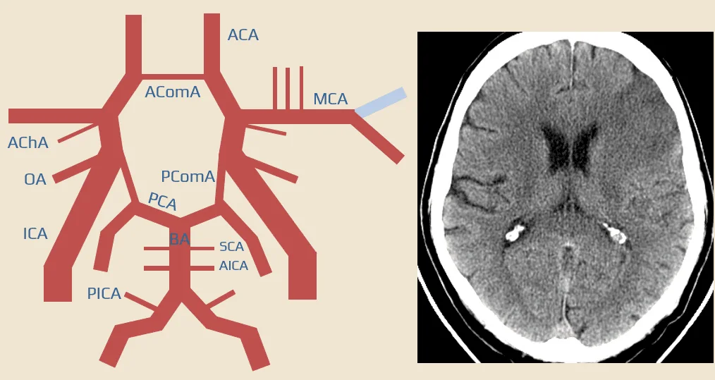 Occlusion of the superior M2 branch of the MCA