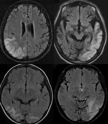 Typical MRI lesions in MELAS