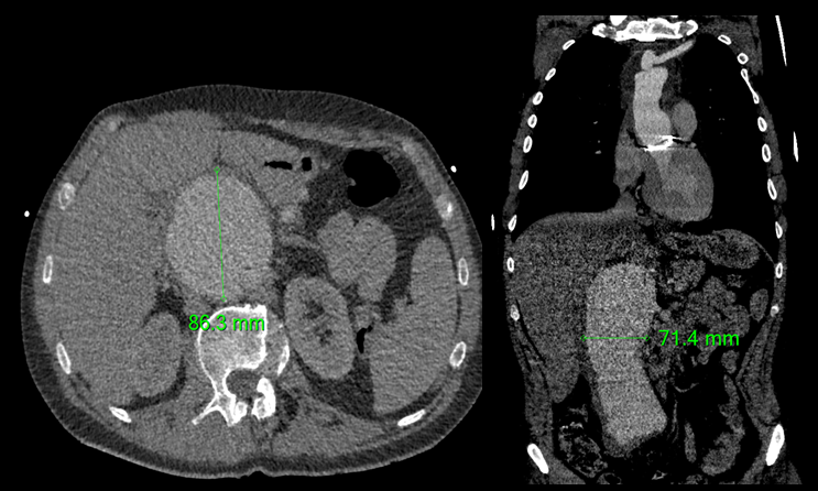 Dilated descending and abdominal aorta in Marfan syndrome