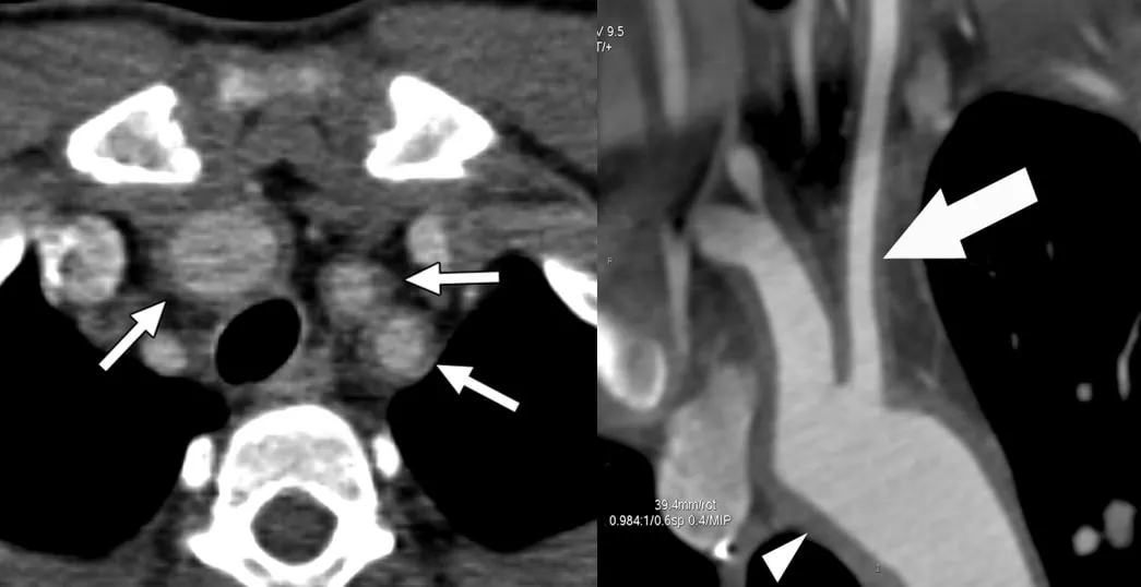 Takayasu arteritis on CTA - typical concentric enlargement of the wall in affected arteries