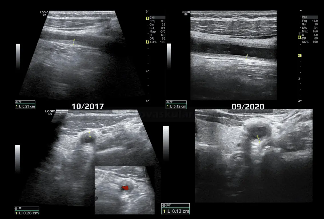 Takayasu arteritis - ultrasound monitoring