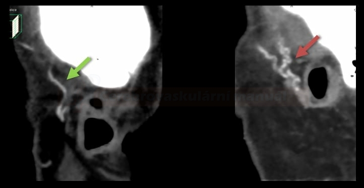 Temporal arteritis on the right image (CTA)