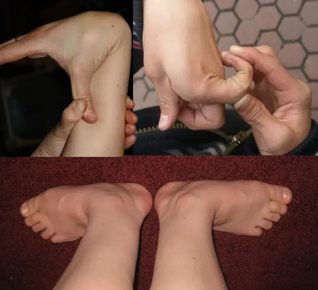 Joint hypermobility in Ehlers-Danlos syndrome