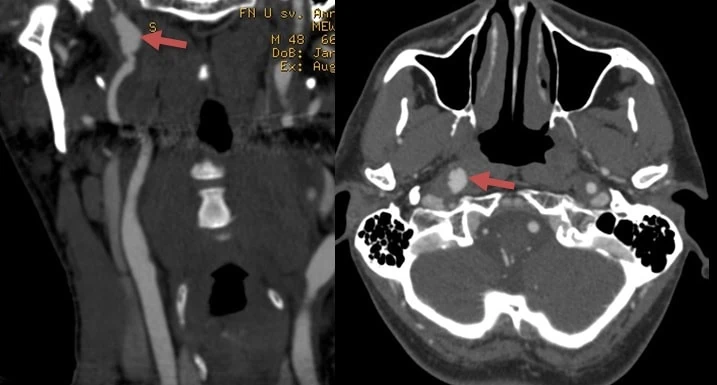 Dissecting aneurysm of the left ICA and aneurysm of the left vertebral artery in a 48-year-old patient with Ehlers-Danlos syndrome