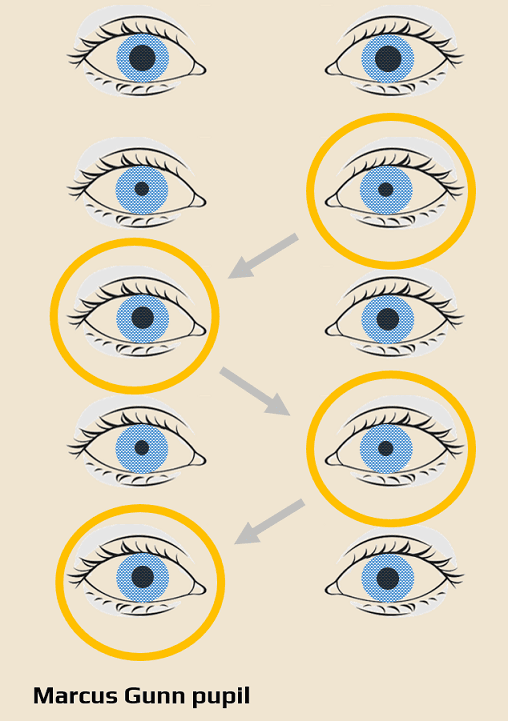 Relative afferent pupillary defect (RAPD) - swinging flashlight test