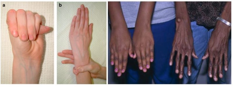 Marfan syndrome - thumb and wrist sign