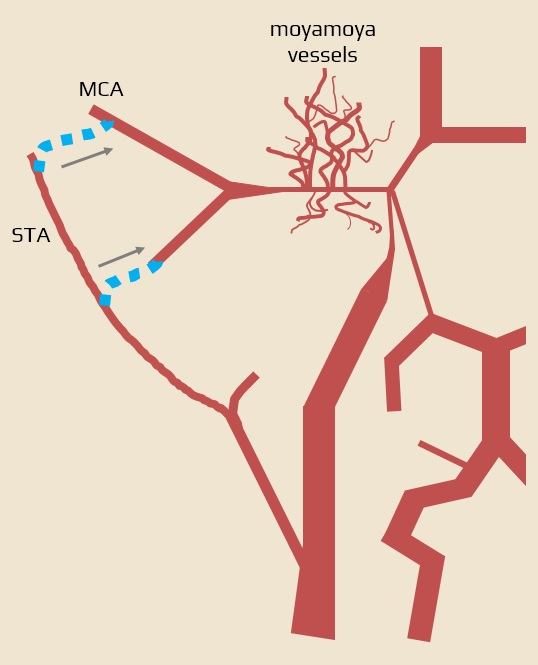Moyamoya disease - STA-MCA bypass
