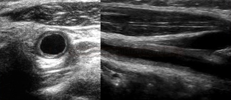 Takayasu arteritis on ultrasound