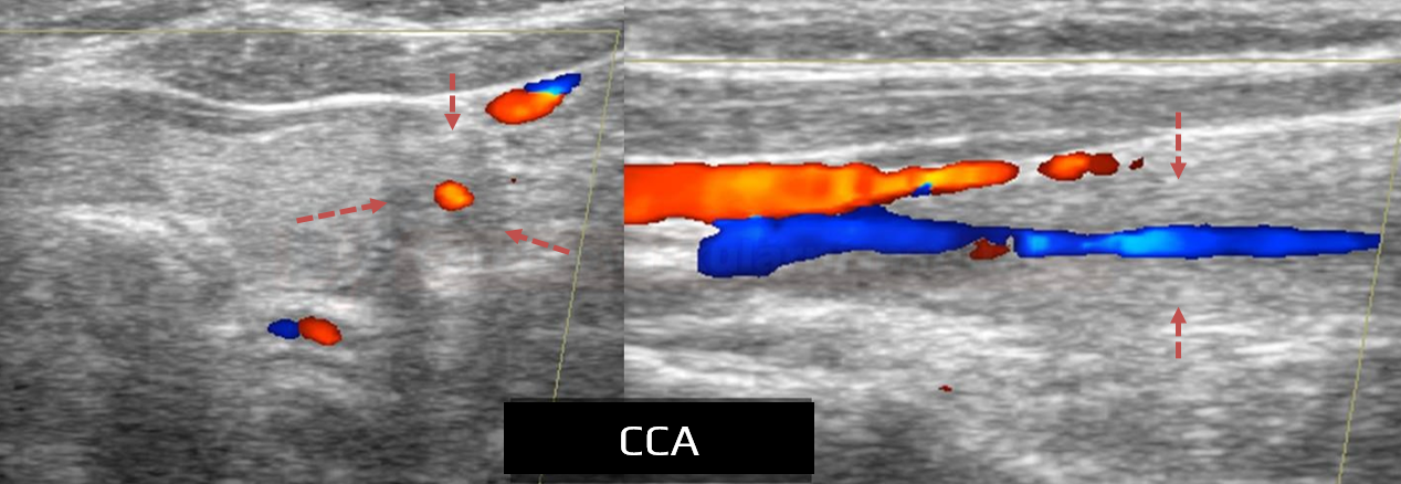 Takayasu arteritis - enlarged wall on ultrasound
