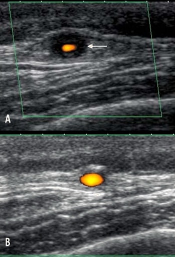 Superficial temporal artery on the ultrasound - above the enlarged wall in the acute stage, below normalization after corticotherapy [Suelves, 2010]