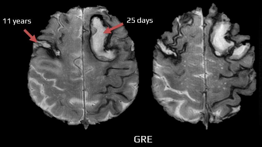 Cortical siderosis and chronic and late-subacute lobar hematoma in a patient with CAA