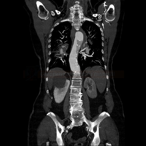 Aortic dissection on CTA