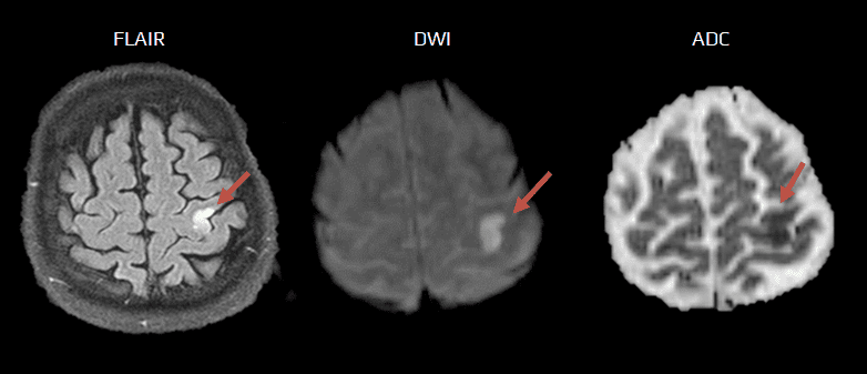 Patient with severe right acral monoparesis. IV thrombolysis was ineffective. MRI was performed 36 hours later