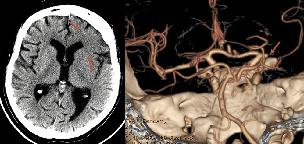 Patient with a generalized epileptic seizure at the onset of acute stroke. NCCT shows early signs of ischemia, CTA occlusion in the right MCA