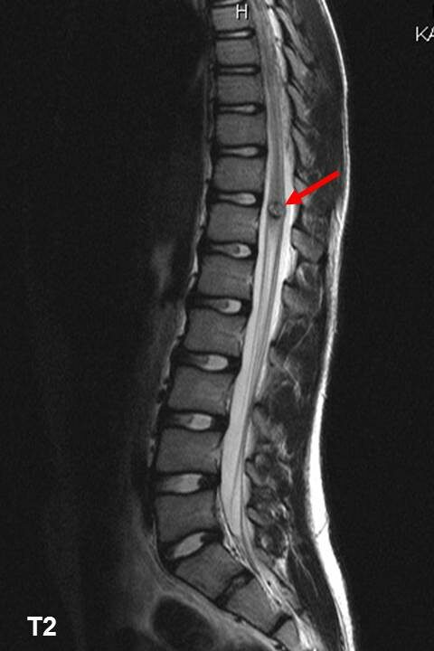 Spinal cavernoma on T2 images