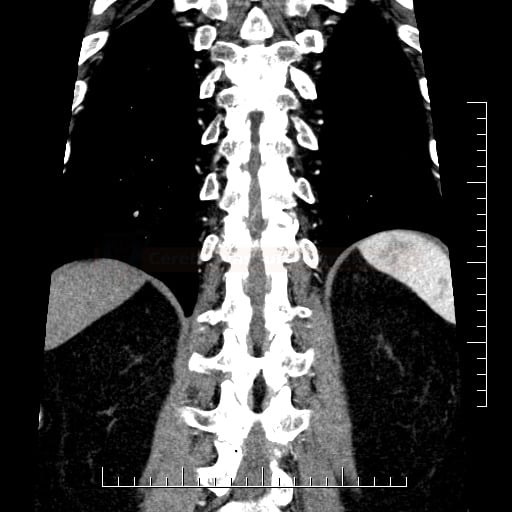 Spinal AV malformation