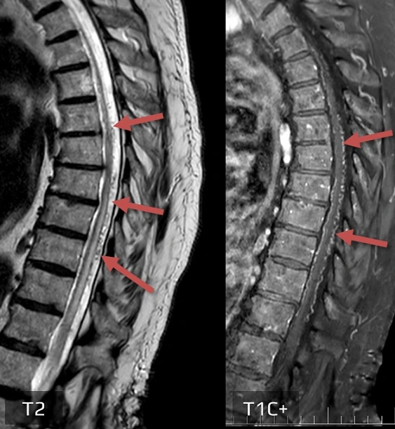 Spinal AVM on MRI