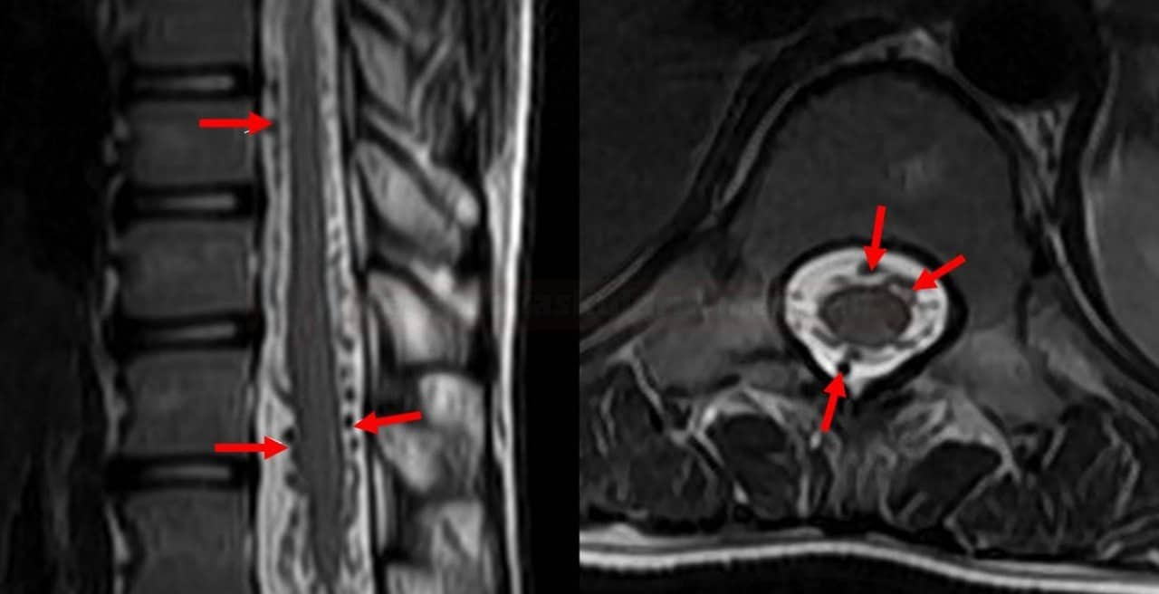 Spinal AVM on MRI