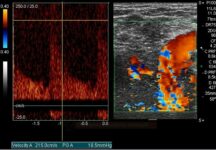 Stenosis of V0 segment on the ultrasound (PSV 215 cm/s)