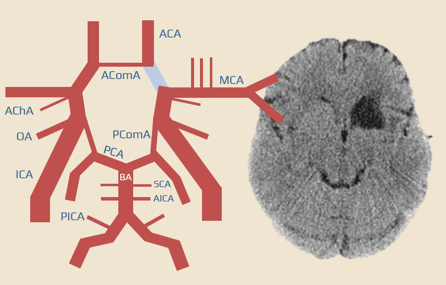 Infarct due to an isolated occlusion of the A1 segment