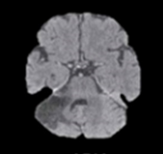 Infarct caused by the AICA occlusion