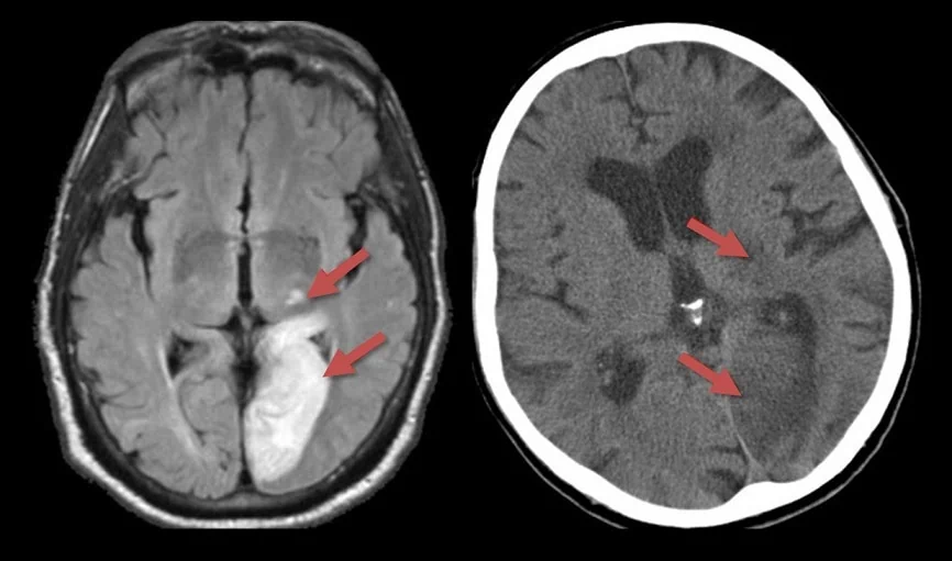 Infarct caused by the P1 segment occlusion