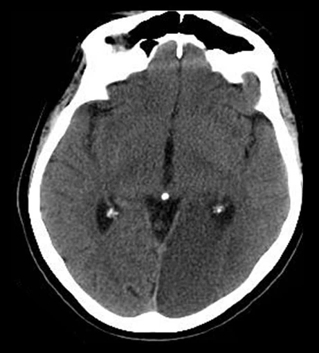 Infarct caused by the P2 segment occlusion