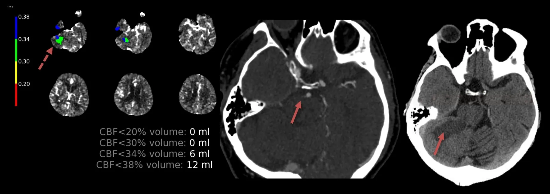 Infarct caused by the SCA occlusion
