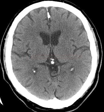 Lacunar infarct in the right thalamus