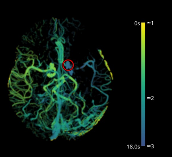 E-CTA (Brainomix) shows the left ICA and MCA occlusion