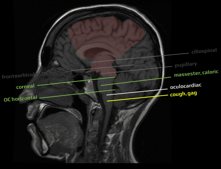 Lesion has reached the mesencephalo-potine junction (reflexes from the upper brainstem are absent)