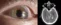 Oval pupil due to mesencephalic hemorrhage