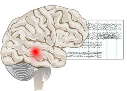 Stroke-related epilepsy