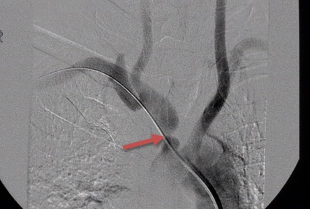 Stenosis of the brachiocephalic trunk (innominate artery) on DSA