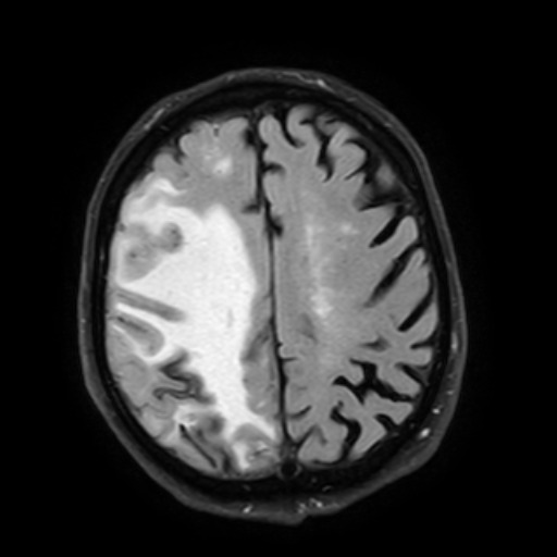 Cerebral amyloid angiopathy-related inflammation