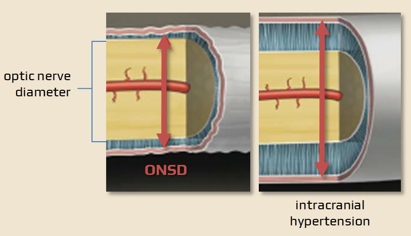 Optic nerve sheath diameter (ONSD)