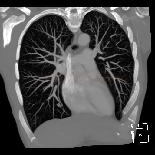 Pulmonary A-V malformation on CTA