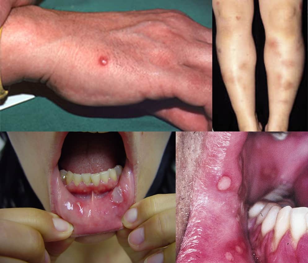 Ulcerations and skin lesions in Behcet disease