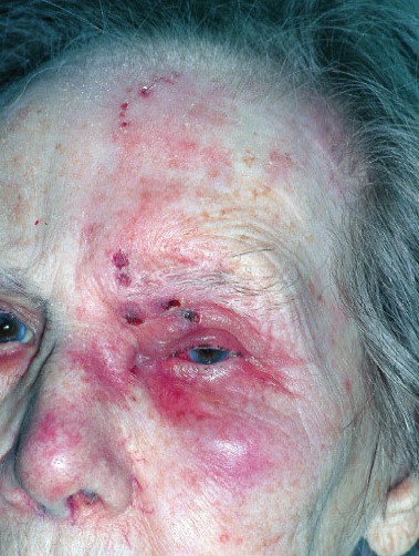 Ohthalmic herpes zoster