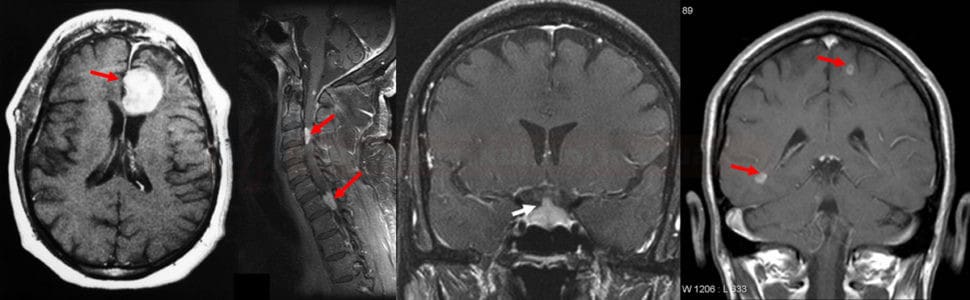 Neurosarcoidosis on MRI