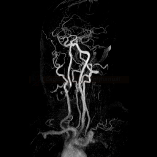 Těsná stenóza ACI dx na MRA